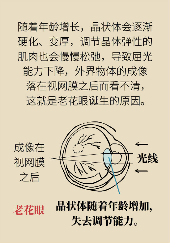 关于老花眼这些知识你要了解